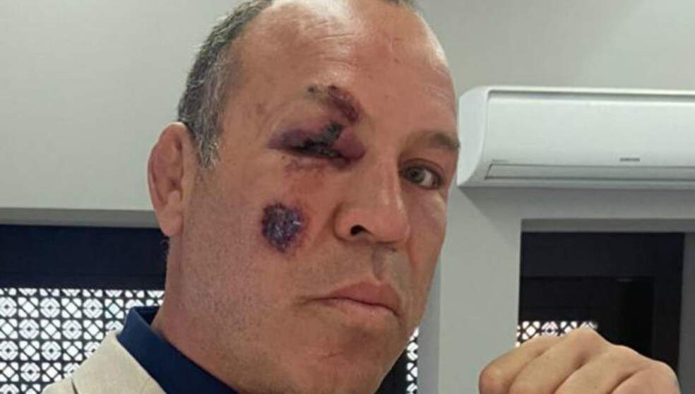 De bicicleta, Wanderlei Silva é atropelado em Curitiba e sofre fratura no pé
