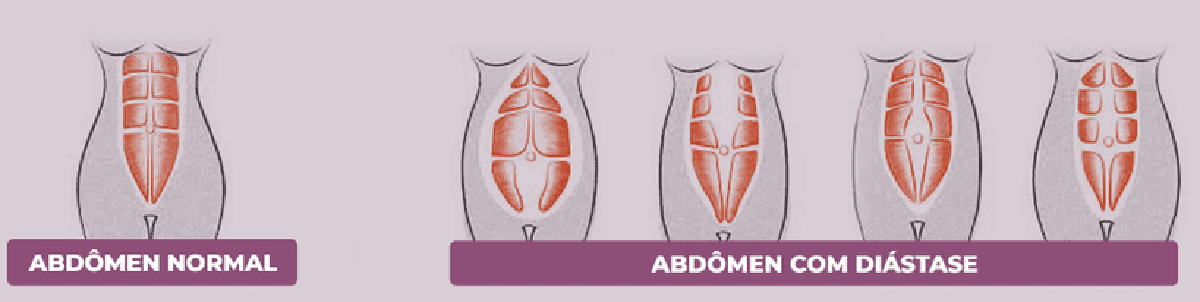 O que não fazer para piorar a diástase - O Liberal