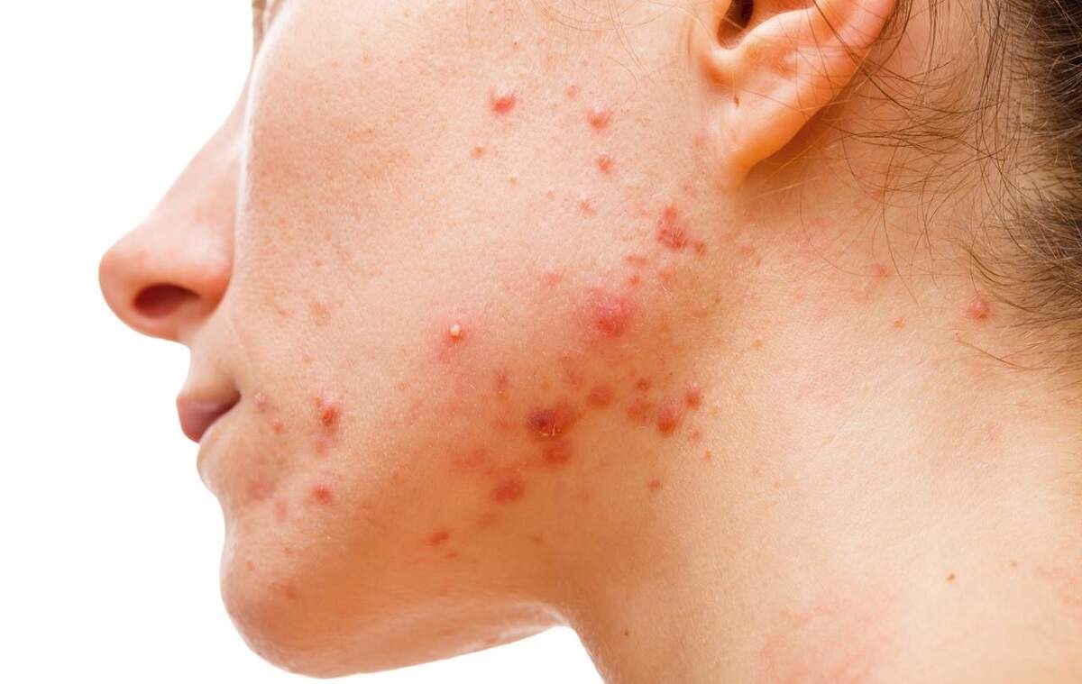 Mitos e Verdades sobre acne na mulher adulta
